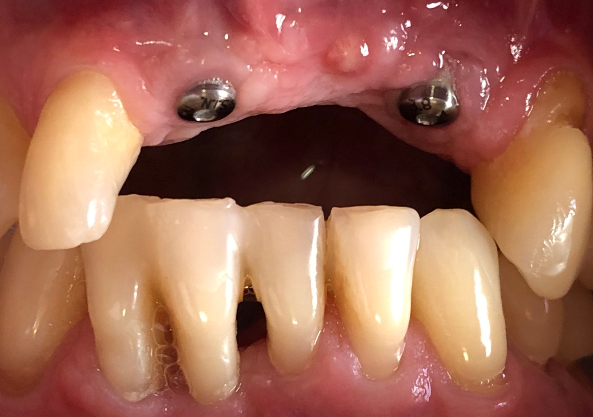 Clínica Odontológica OverClin - Implante