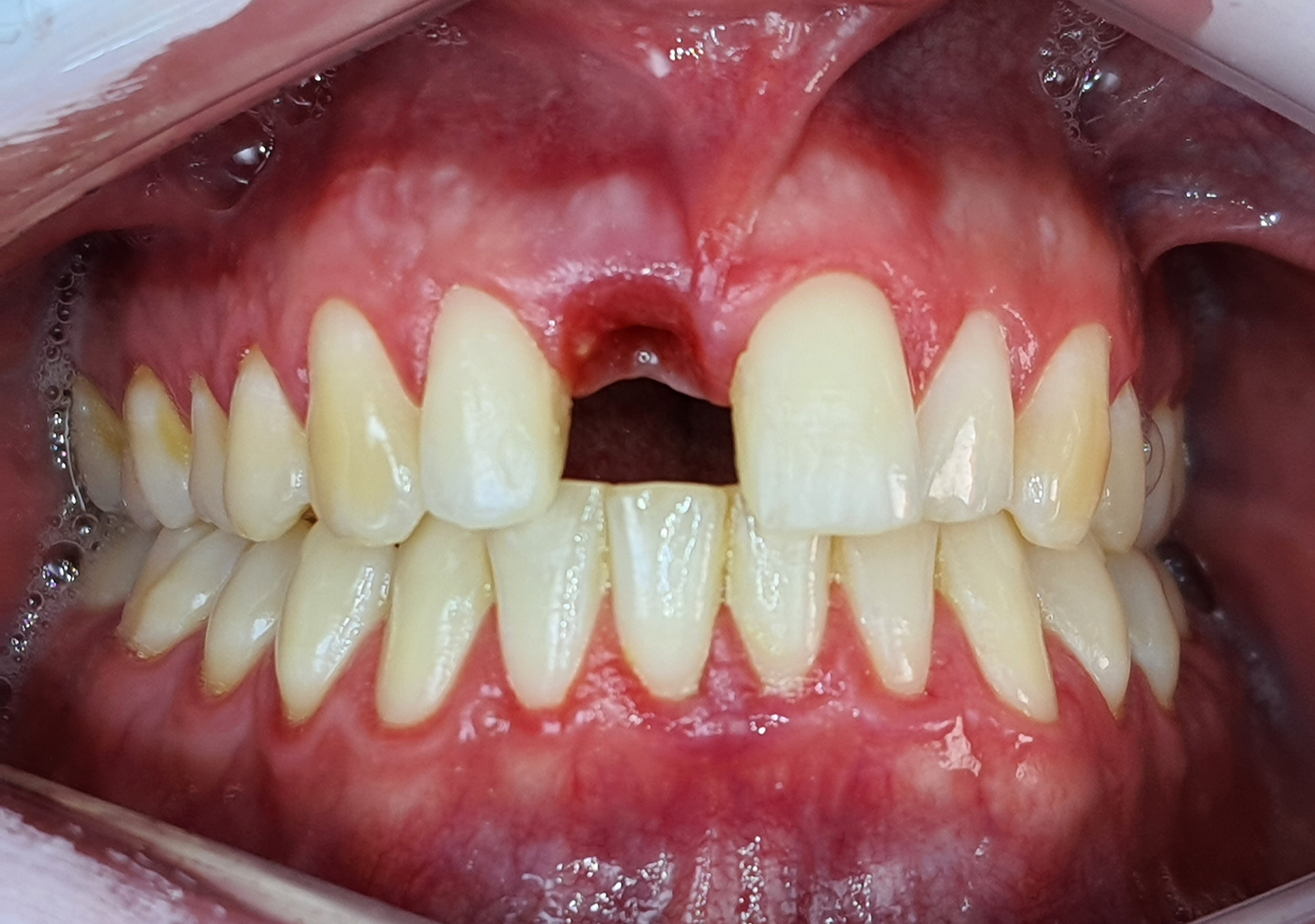 Clínica Odontológica OverClin - Implante