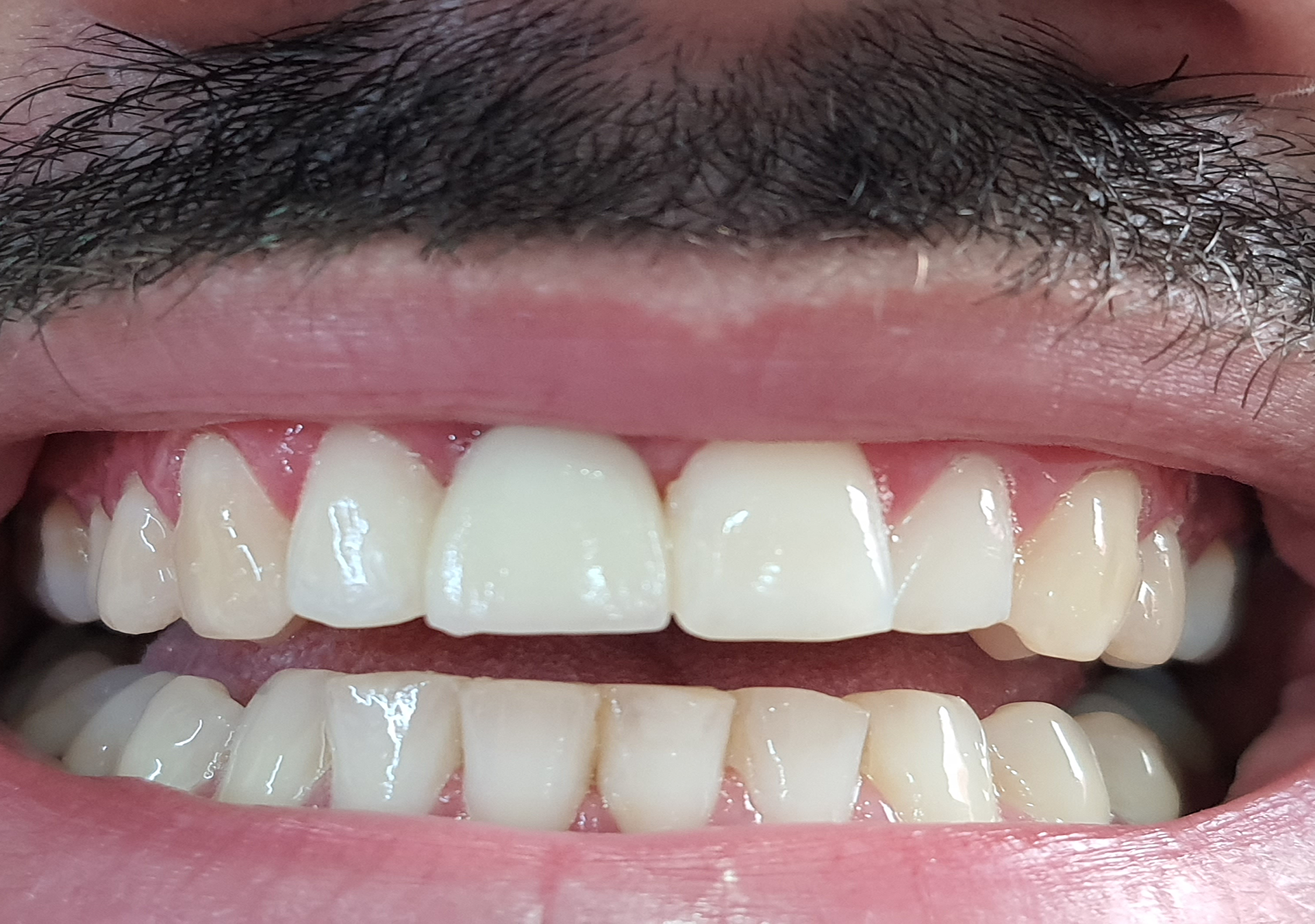 Clínica Odontológica OverClin - Implante